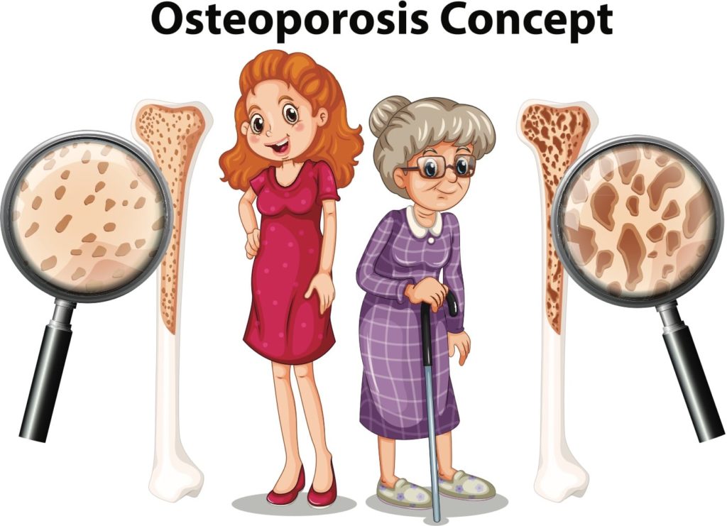osteoporosis osteopenia bone health torrance atlantis physical therapy